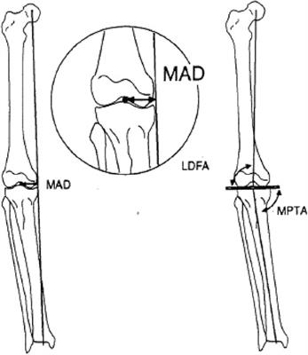 Multi-segment osteotomy with interlocking intramedullary nail fixation in the treatment of lower limb deformity in older children with hypophosphatemic rickets
